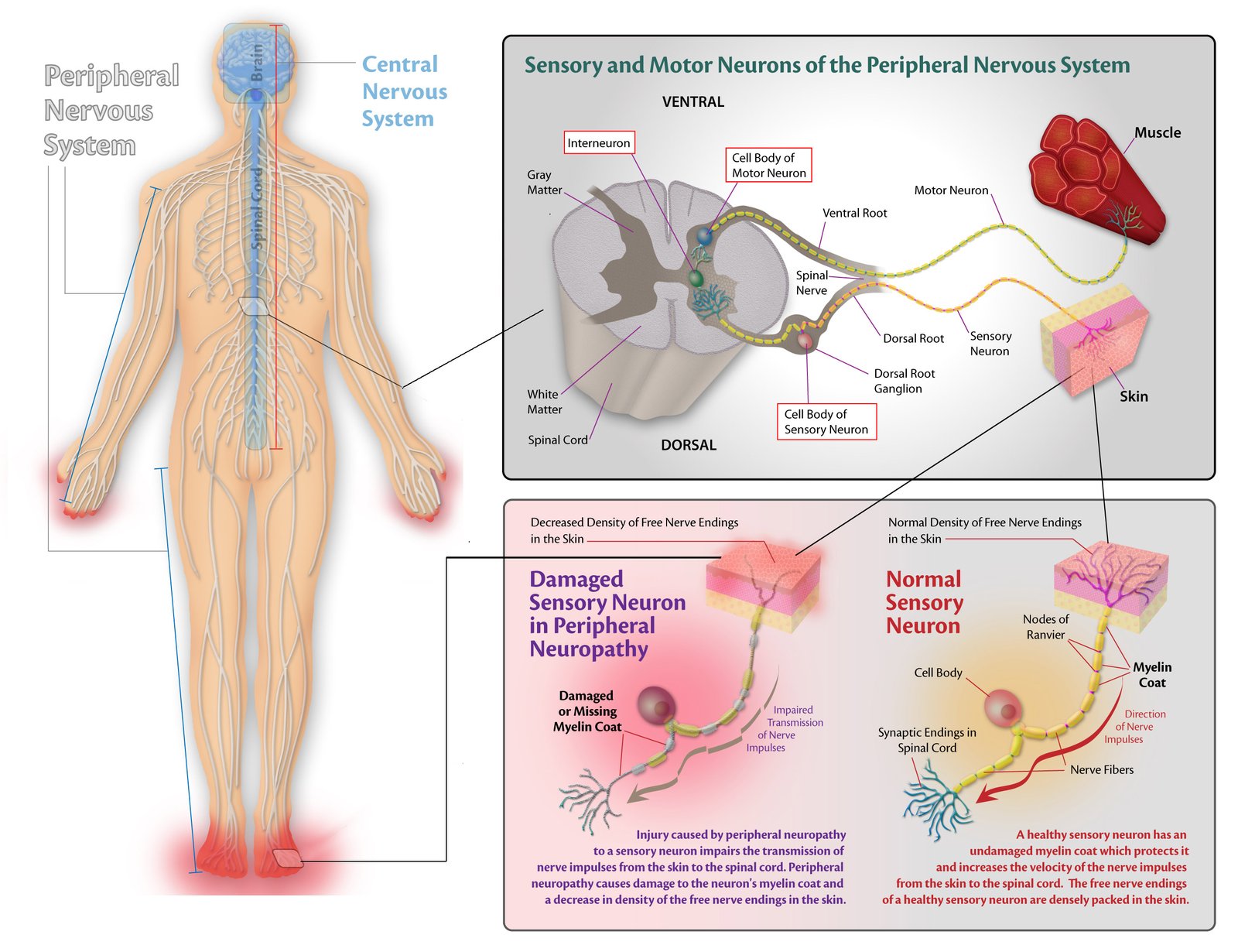 1-what-is-peripheral-neuropathy-peripheral-neuropathy-help-center